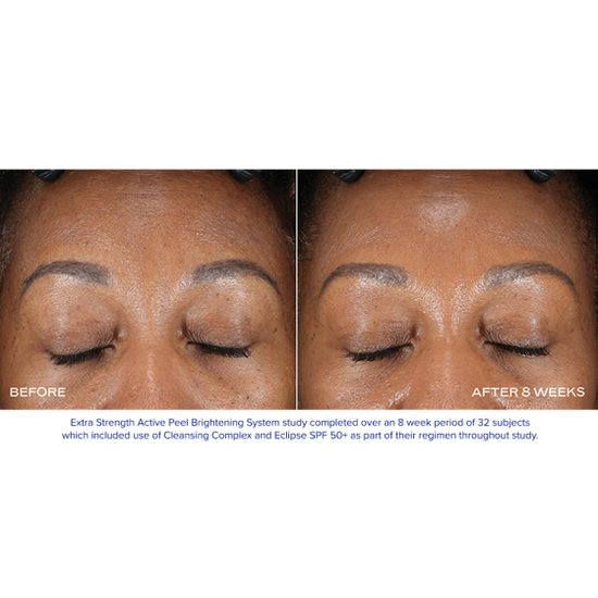 iS Clinical Extra Strength Active Peel Pads | Bare Complexion Acne & Skincare in Ventura, CA