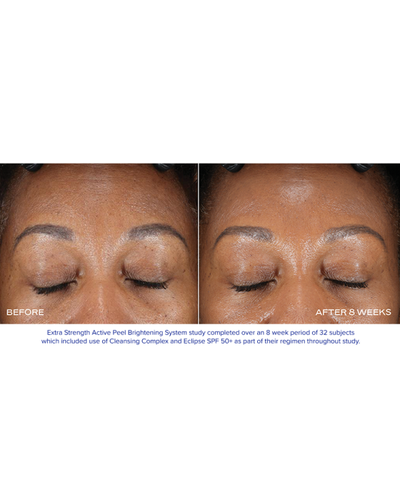 iS Clinical Extra Strength Active Peel Pads | Bare Complexion Acne & Skincare in Ventura, CA
