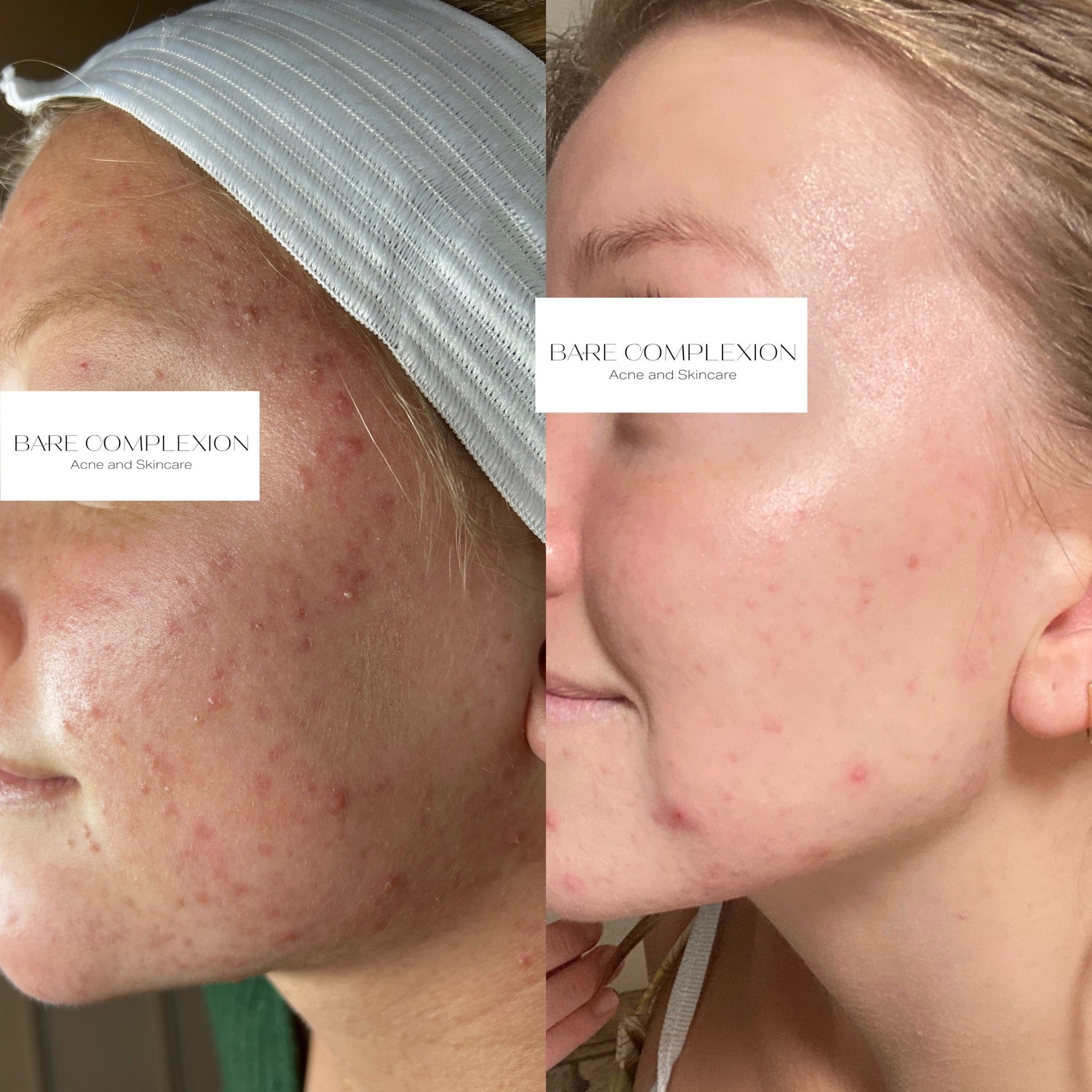 Virtual Consultation | Bare Complexion Acne and Skincare in Ventura, California