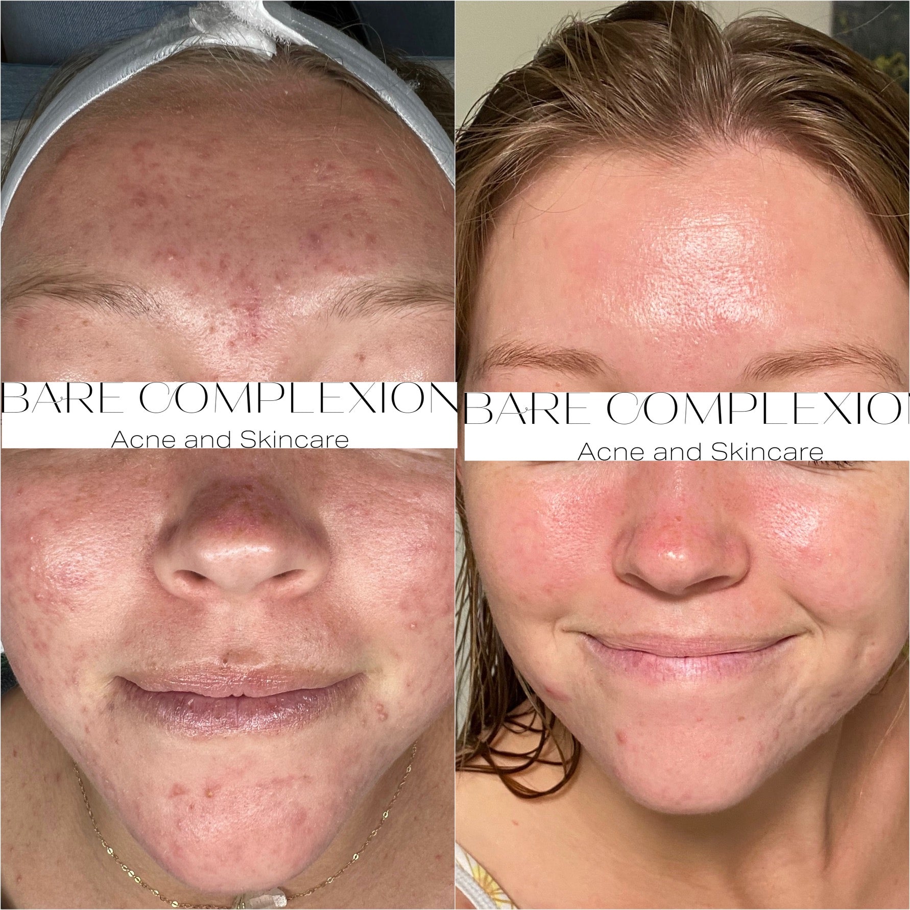 Virtual Consultation | Bare Complexion Acne and Skincare in Ventura, California