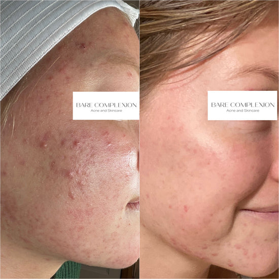 Virtual Consultation | Bare Complexion Acne and Skincare in Ventura, California