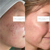 Virtual Consultation | Bare Complexion Acne and Skincare in Ventura, California